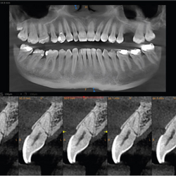 CBCT